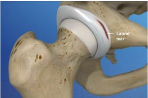 Hip Labral Tear Photo 