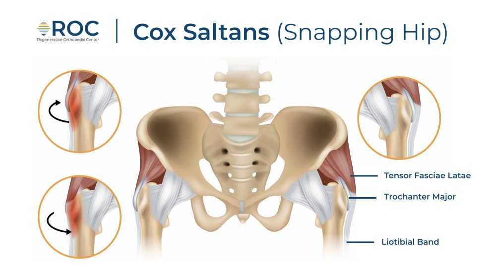 Snapping Hip Syndrome: Causes, Symptoms, and Effective Treatments with ...