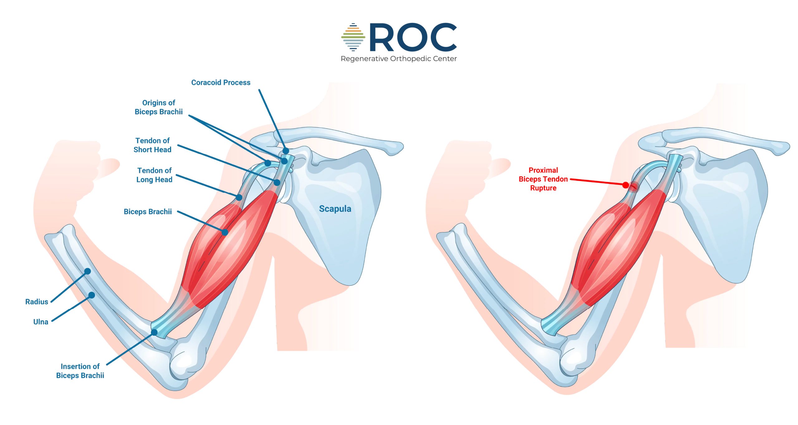 proximal bicep tendon injury diagram