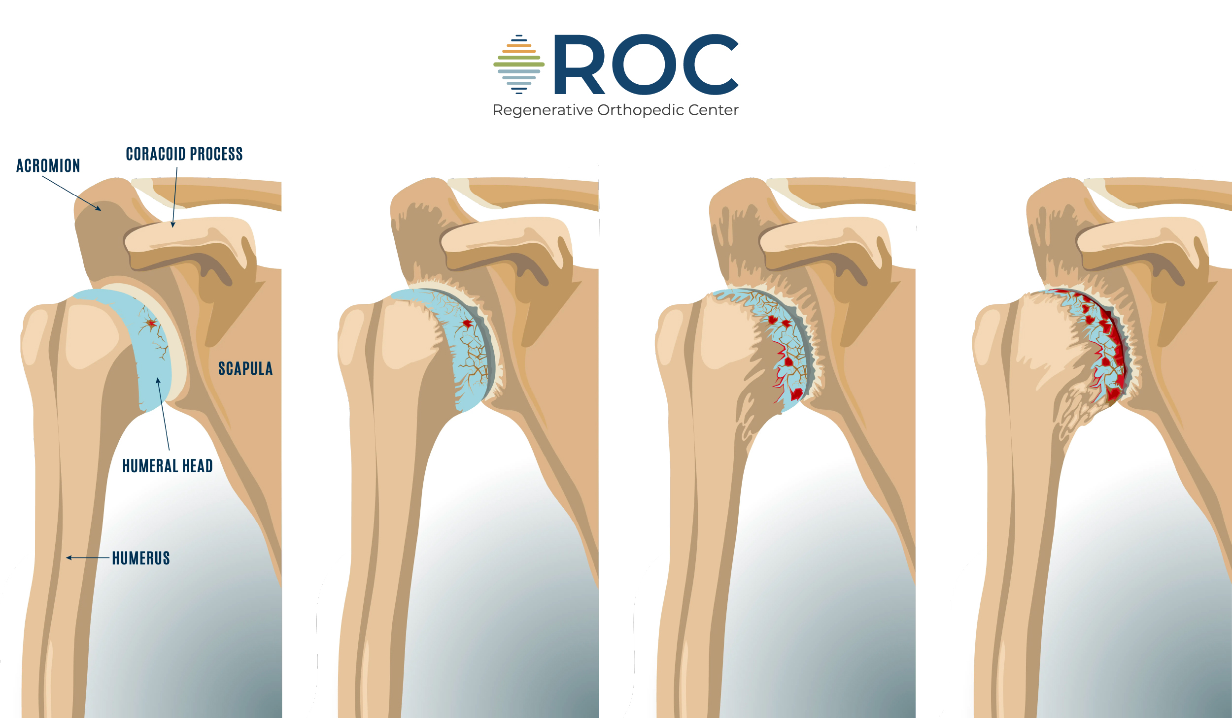 shoulder arthritis diagram