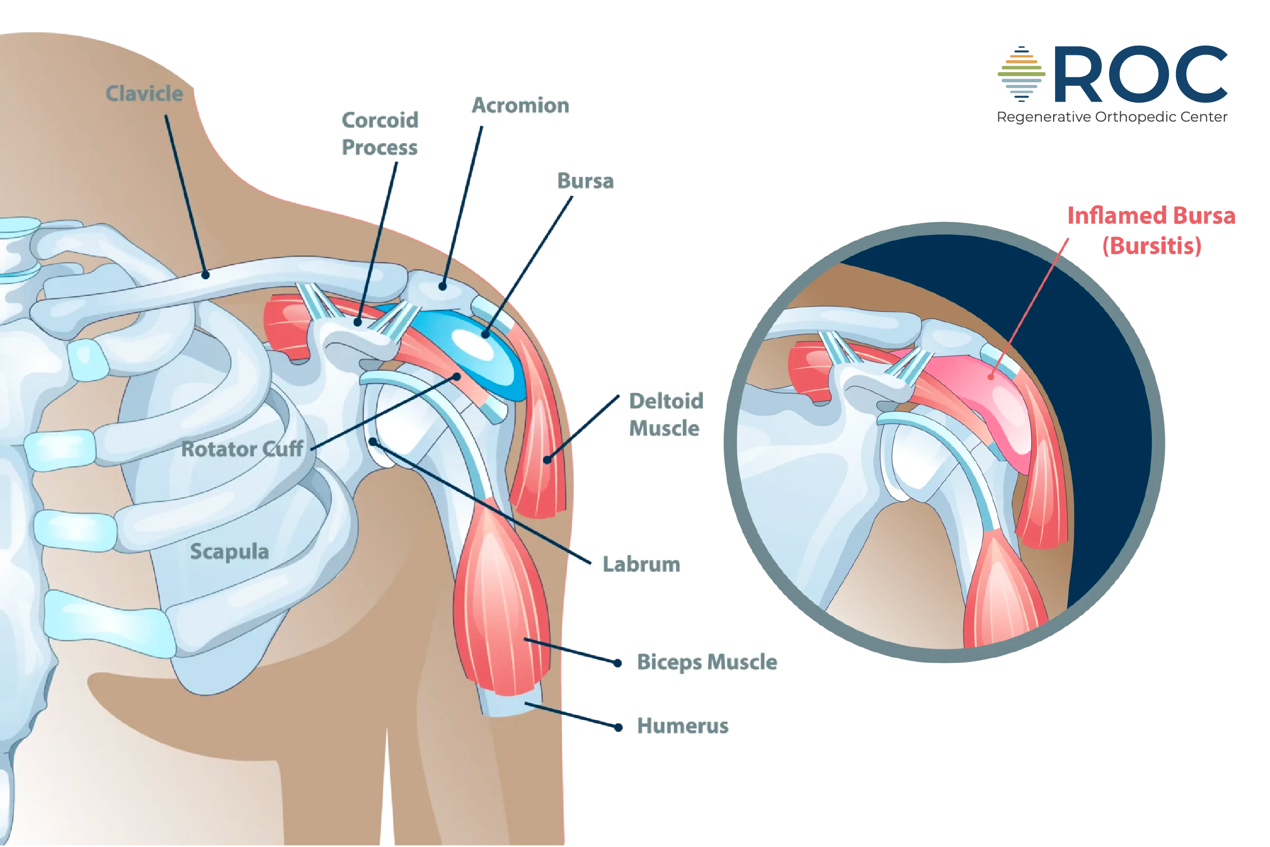 shoulder bursitis diagram