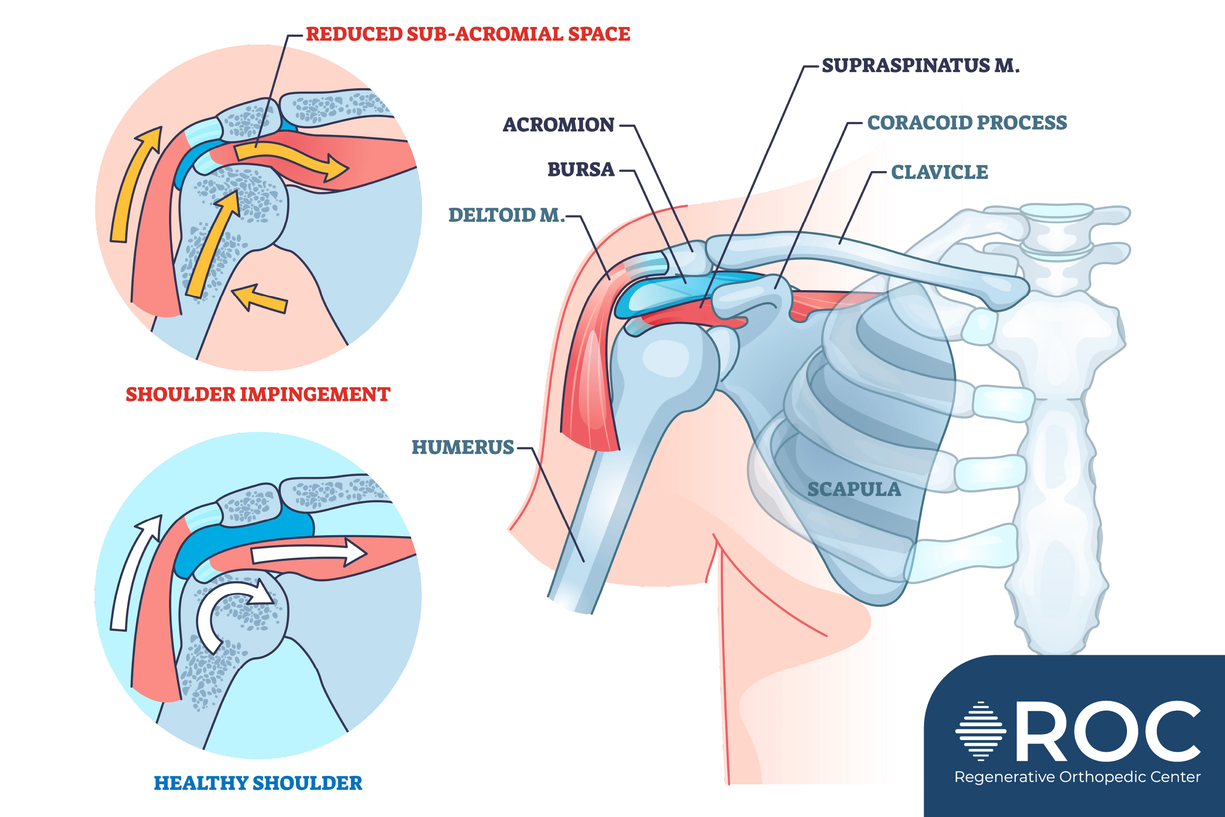shoulder impingement diagram